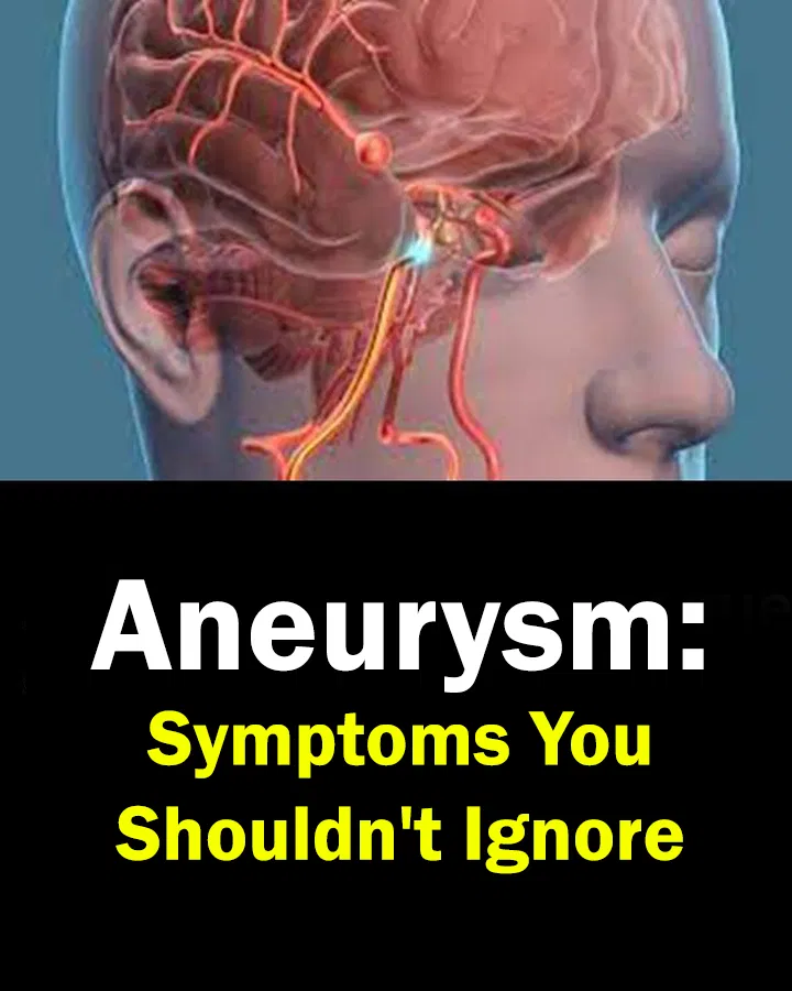 Aneurysm: Symptoms You Shouldn’t Ignore