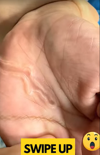 Teen in Florida Suffers Painful Parasitic Infection Linked to Contaminated Sand Teen in Florida Suffers Painful Parasitic Infection Linked to Contaminated Sand